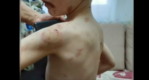 Cледы от побоев на теле ребенка. Стоп-кадр видео https://ok.ru/video/1483245947588