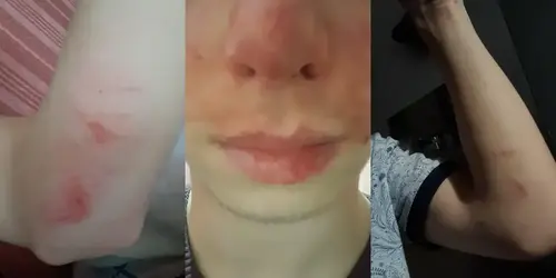 Следы от побоев на теле подростка. Скриншот фото Кризисной группы СК SOS (признана иноагентом).